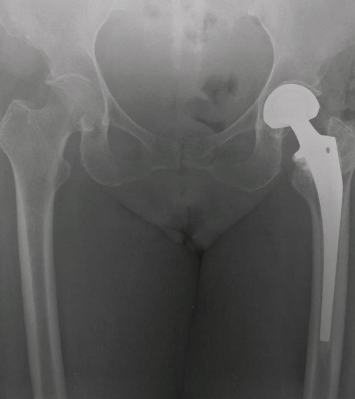 Artroplastia de cadera 